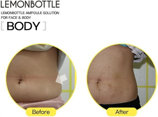 Lemon Bottle 10ml*5 Mencabut Lemak Berlebih dan Menurunkan Berat Badan Lipolab Kabelline